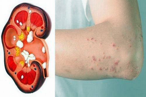 Ngứa kéo dài không rõ nguyên nhân: Cảnh báo sớm suy thận